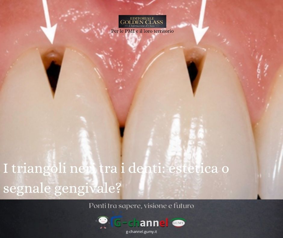 I triangoli neri tra i denti: estetica o segnale gengivale?